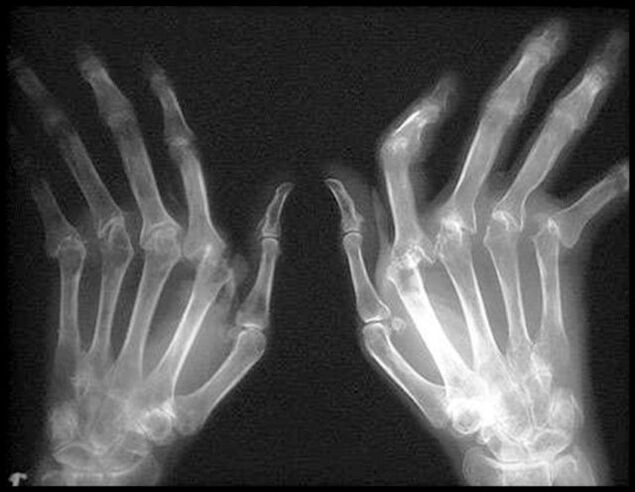 Foto x -ray e duarve të prekura nga artroza