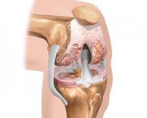 faza fillestare e artrozës së gjurit