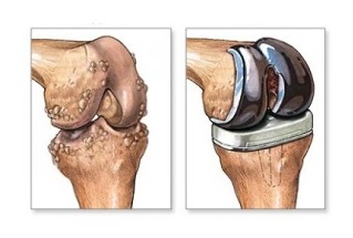 zëvendësimi i gjurit për artrozë