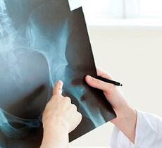 si të trajtohet artroza e bashkimit të hip
