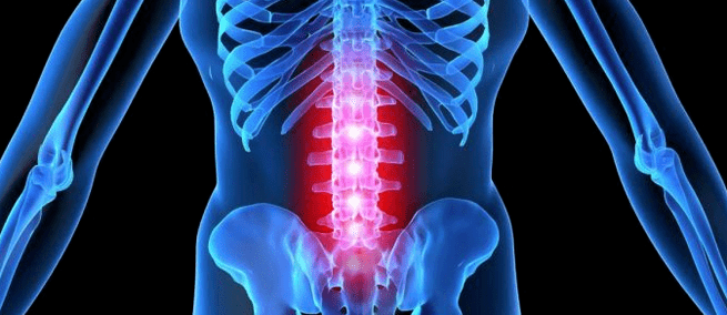 Deformimi i diskut intervertebral
