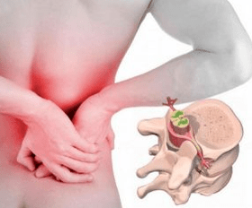 Lumbago në fillim të sëmundjes osteokondroza