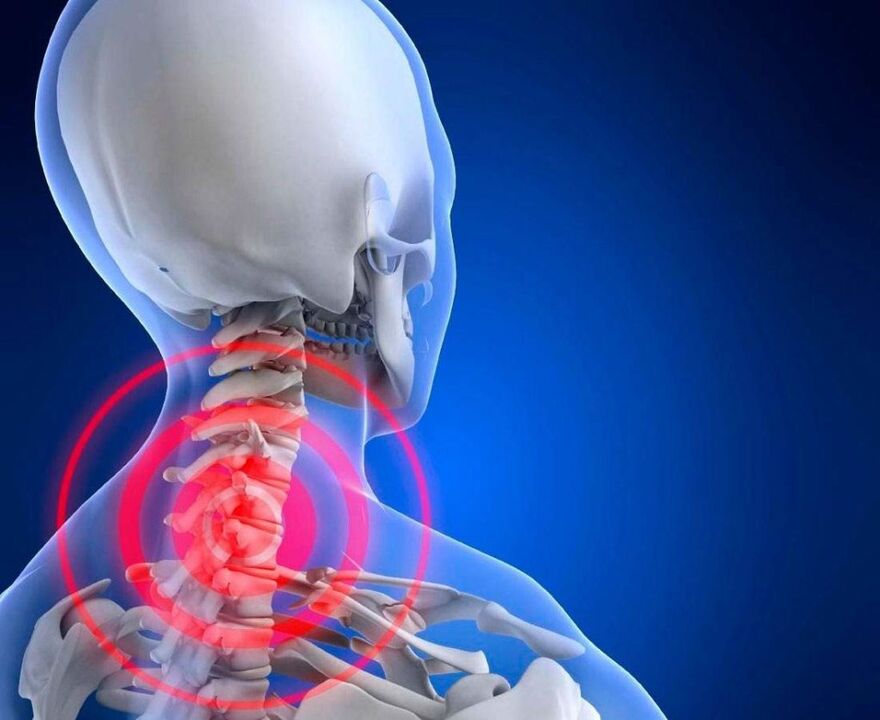 dhimbje në qafë me osteokondrozë të qafës së mitrës