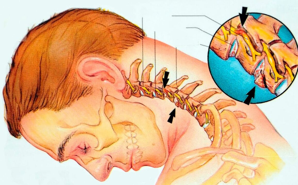 Çfarë është osteokondroza e qafës së mitrës