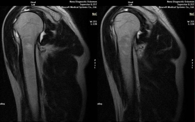 artroza e nyjës së shpatullës në x-ray
