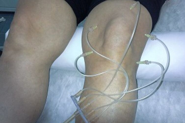 Terapia e ozonit