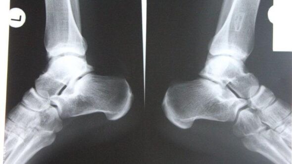 Diagnoza e artrozës së kyçit të këmbës duke përdorur radiografi