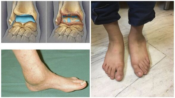 Ënjtje dhe deformim i kyçit të kyçit të këmbës për shkak të artrozës