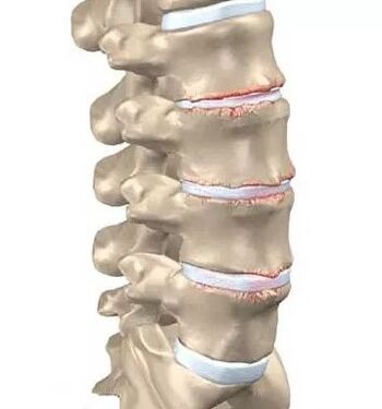 Osteokondrozë